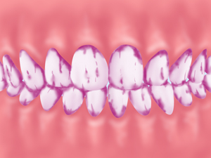 プラーク（歯垢）の染め出し