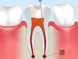 感染根管治療