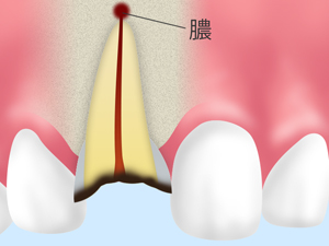 歯根端（しこんたん）切除